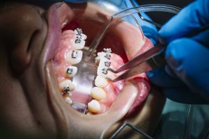 Teeth Straighting