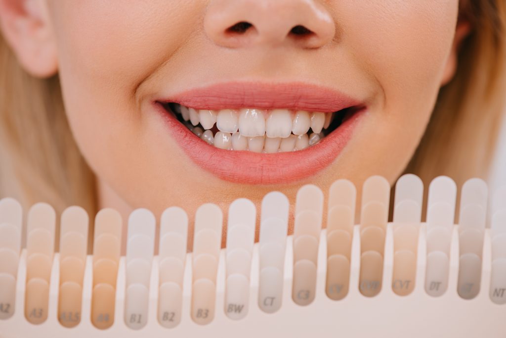 Professional Teeth Whitening vs Bleaching
