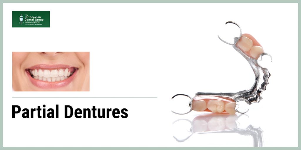 Partial Dentures