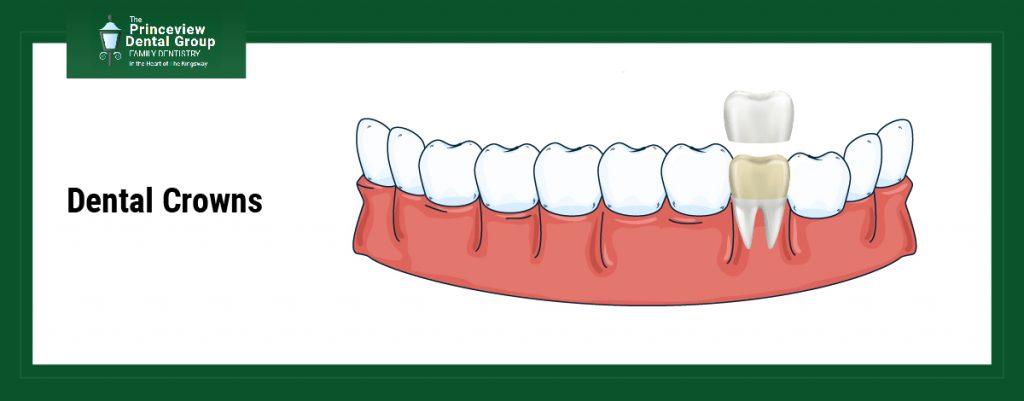 Dental Crowns
