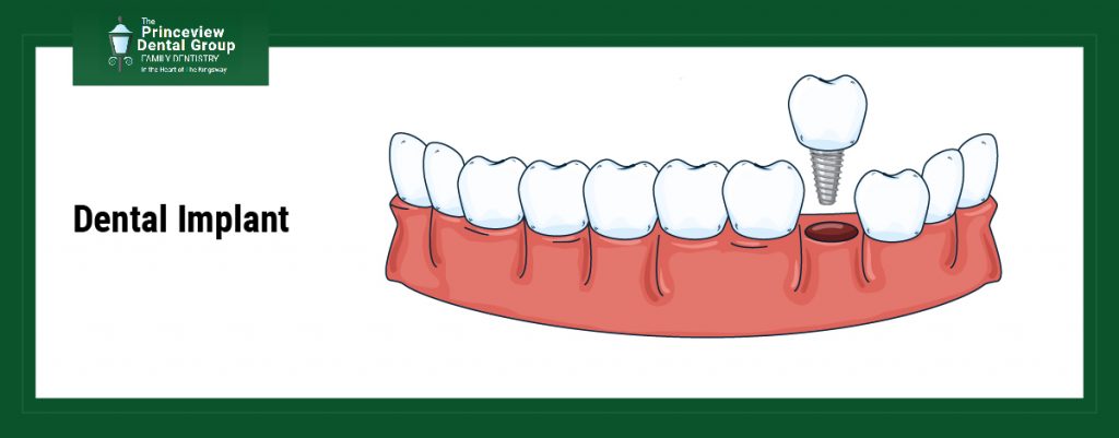 Dental Implants