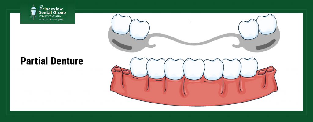Tooth Extraction and Dentures: