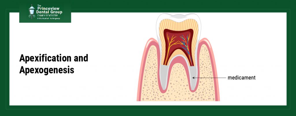 Apexification and Apexogenesis