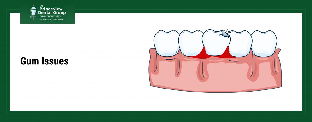 Gum Issues
